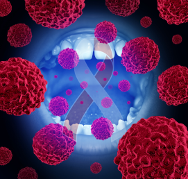 Oral cancer screening service in Bogura for early detection at Namira Oro Dental Care