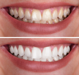 Professional teeth whitening service in Bogura at Namira Oro Dental Care for a brighter smile