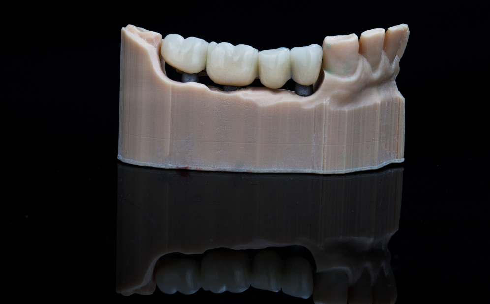 Durable dental bridges treatment in Bogura at Namira Oro Dental Care